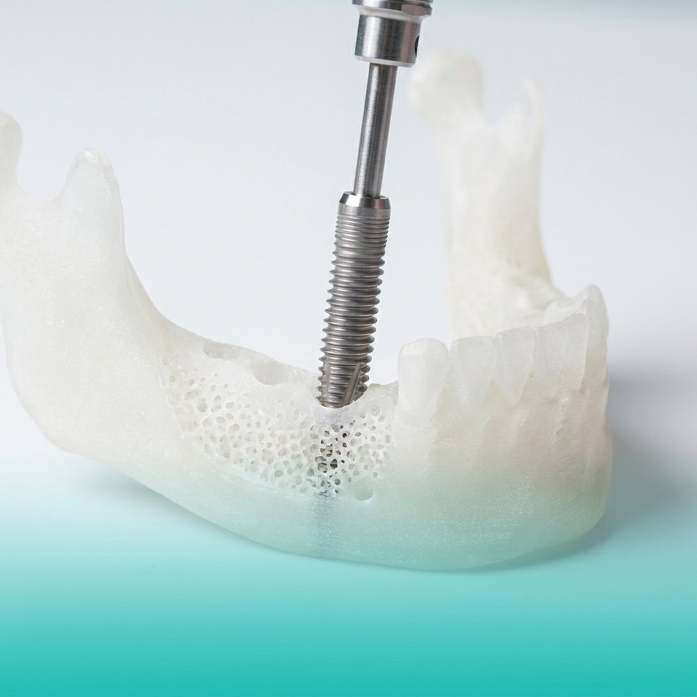 Implante Dentário em Tramandaí — Oral Unic Tramandaí