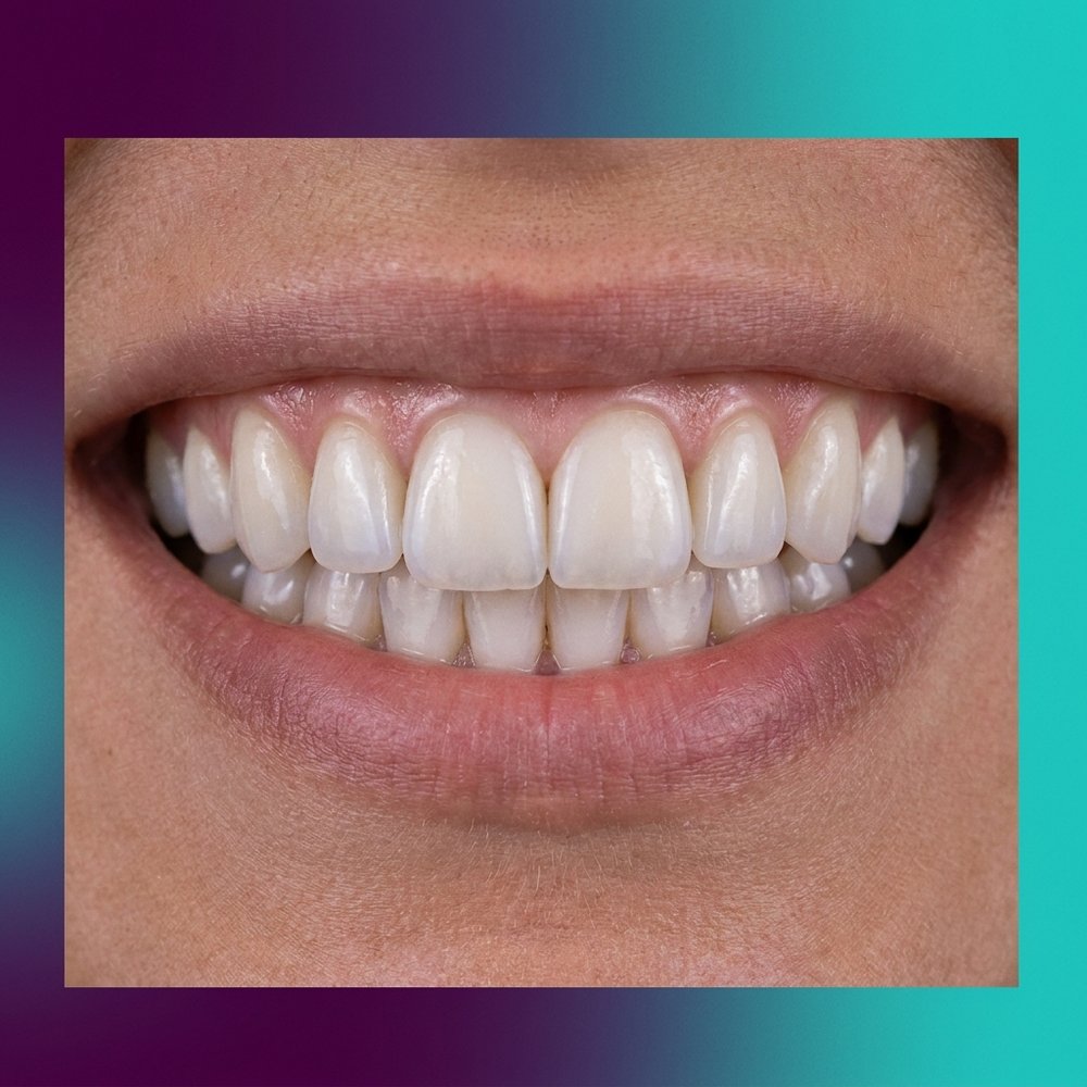 Lentes de Contato Dental em Tramandaí — Oral Unic Tramandaí