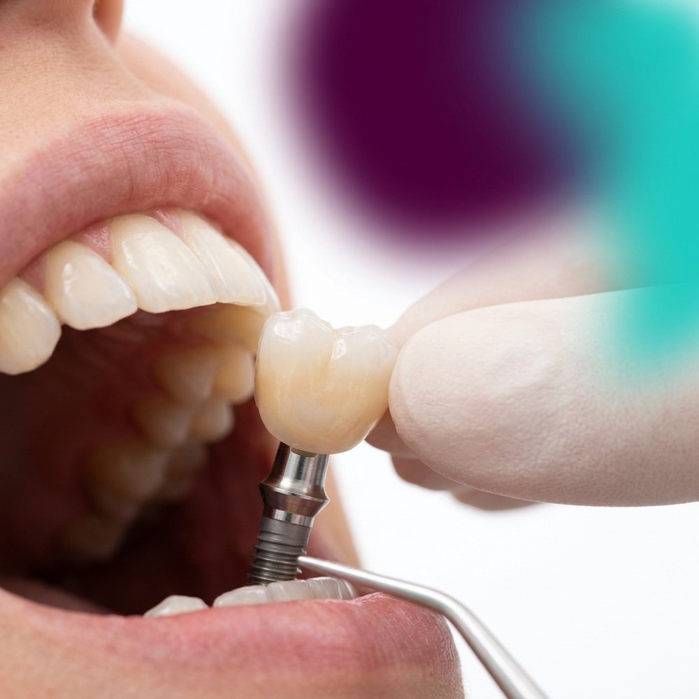 Prótese sobre Implante em Tramandaí — Oral Unic Tramandaí